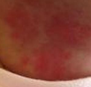 宝宝红色胎记会消退吗_红色胎记需要治疗吗