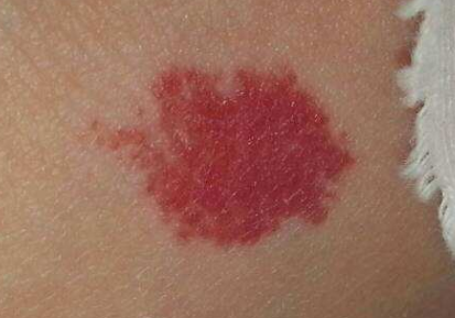 宝宝红色胎记会消退吗_红色胎记需要治疗吗