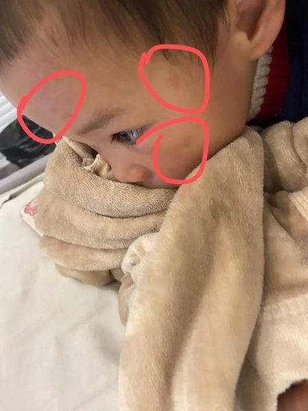 两岁宝宝脸上长斑怎么办_两岁宝宝脸上长斑的原因