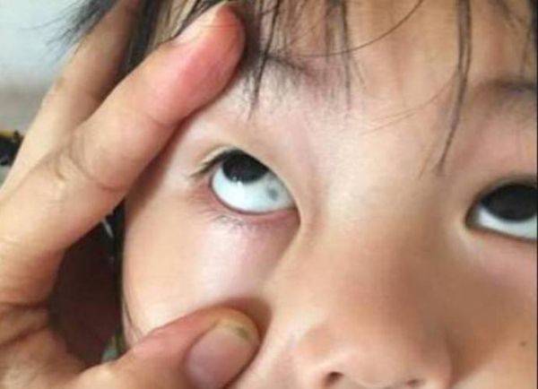 三岁宝宝眼白上有黑斑_需要看医生吗