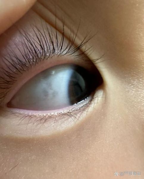 三岁宝宝眼白上有黑斑_需要看医生吗