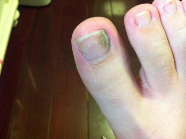 灰指甲图片大全_初期症状有哪些