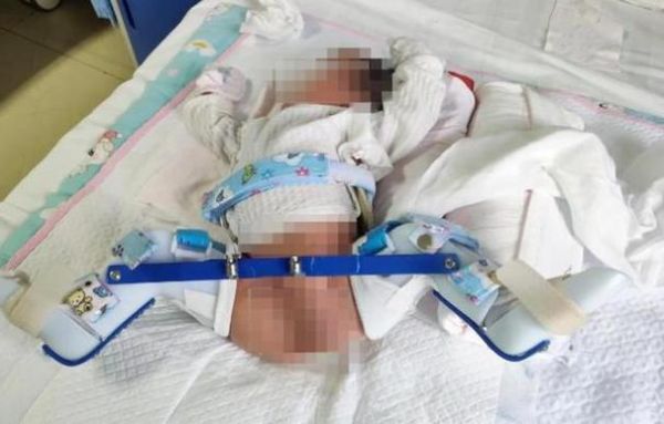 梦到骨折是什么意思_梦见骨折预示什么