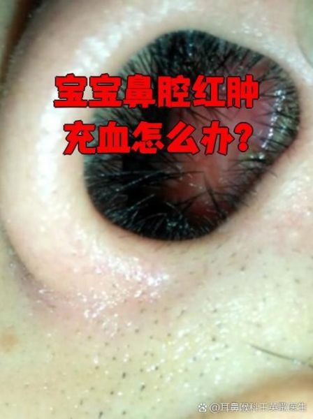 宝宝鼻子里面红肿怎么办_宝宝鼻黏膜红肿多久能好