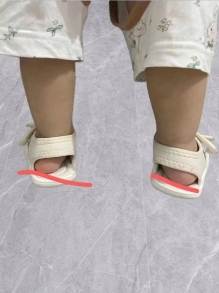 一岁宝宝走路脚往内拐_内八字正常吗