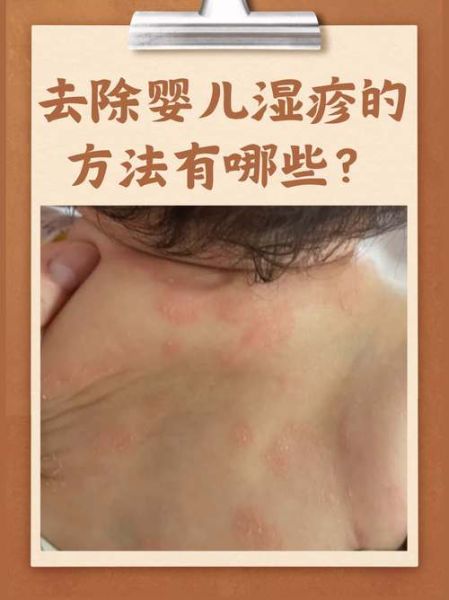 四个月宝宝湿疹最佳治疗方法_宝宝湿疹反复怎么办