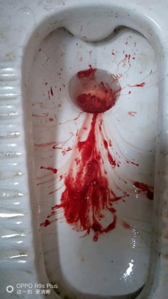 吐血图片大全_吐血是怎么回事