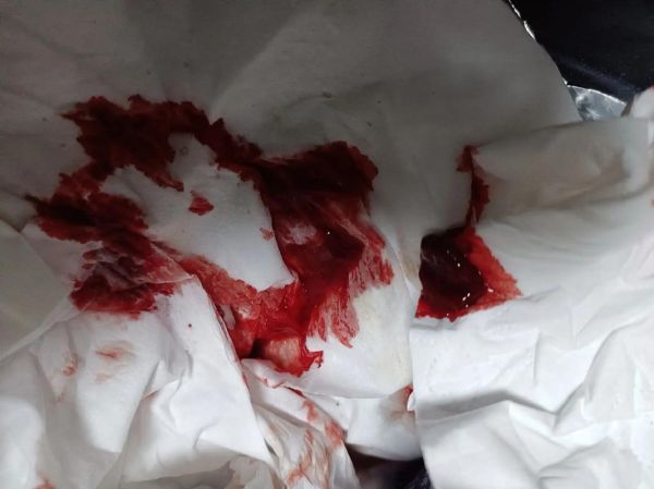 吐血图片大全_吐血是怎么回事