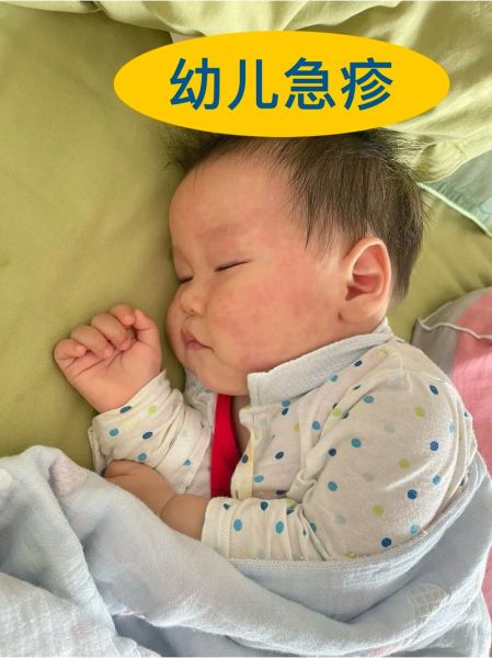 宝宝出幼儿急疹难受吗_幼儿急疹症状会持续多久