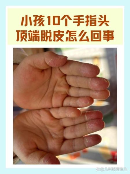 2岁宝宝手指脱皮是怎么回事_手指脱皮缺什么维生素