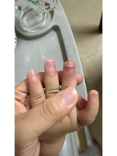 2岁宝宝手指脱皮是怎么回事_手指脱皮缺什么维生素