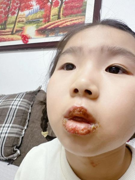 宝宝嘴巴边上长水泡怎么回事_怎么处理