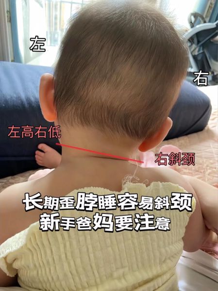 宝宝斜颈症状有哪些_婴儿斜颈怎么判断