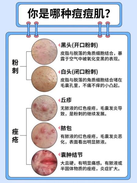 粉刺图片大全_粉刺怎么区分类型