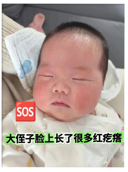 宝宝身上红斑怎么办_新生儿红斑多久能退