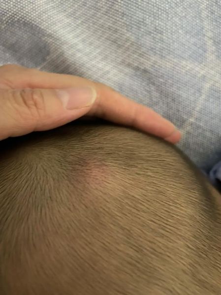 宝宝头上突然鼓起硬包怎么办_宝宝头上硬包多久能消