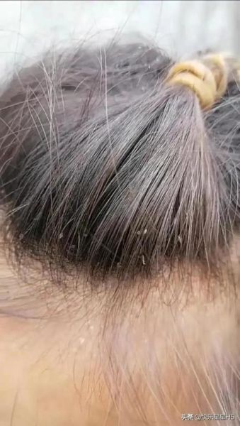 梦到女儿头上长虱子_周公解梦