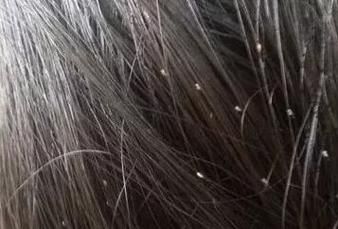 梦到女儿头上长虱子_周公解梦