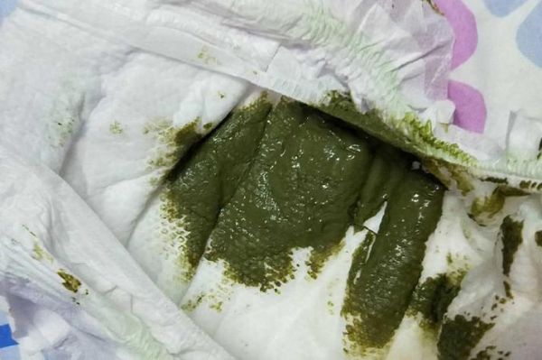 宝宝大便墨绿色偏黑正常吗_需要看医生吗