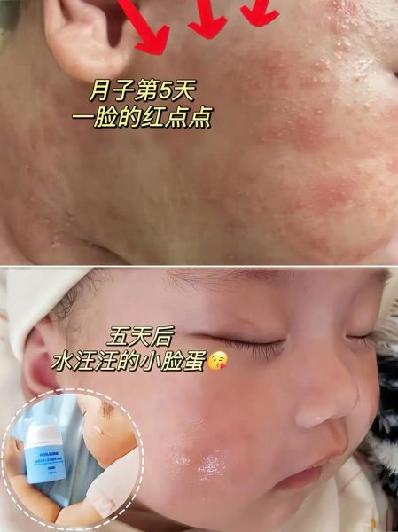 一个月宝宝脸上长了很多小红点_怎么办