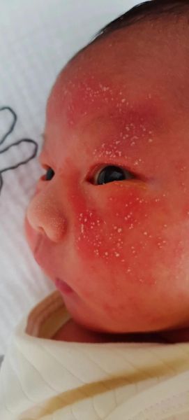 一个月宝宝脸上长了很多小红点_怎么办