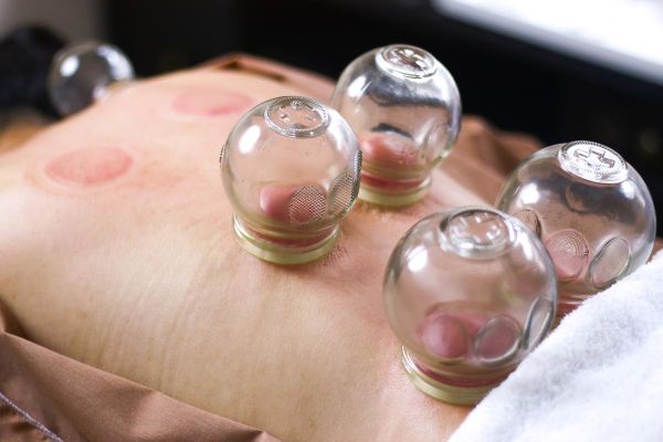 拔火罐图片大全_拔火罐多久一次合适