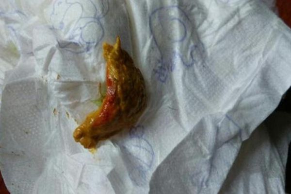 5个月宝宝大便有血丝怎么办_婴儿大便带血原因