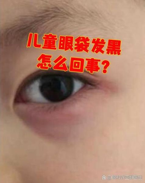 宝宝眼睛有黑点怎么办_宝宝眼睛黑点会消失吗