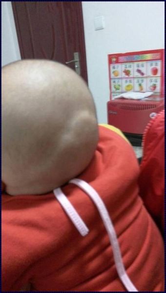 宝宝头后面骨头突出来正常吗_宝宝后脑勺骨头突出怎么办