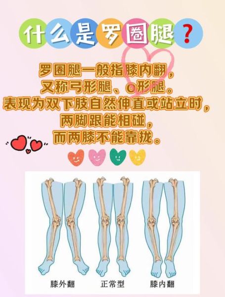 宝宝罗圈腿图片_如何判断是否O型腿