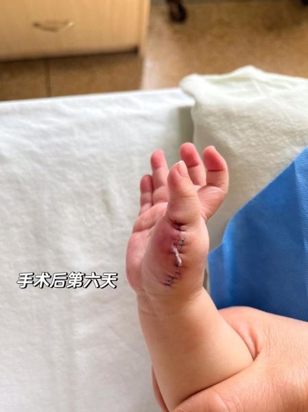 宝宝六指的原因_六指会遗传吗